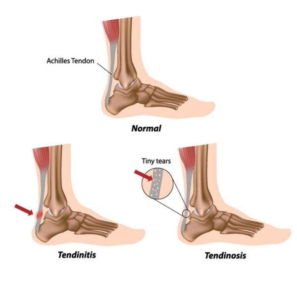 Tendonitis Vs Tendinosiswhats The Difference And How Are They Treated Austin Fit Magazine 3005